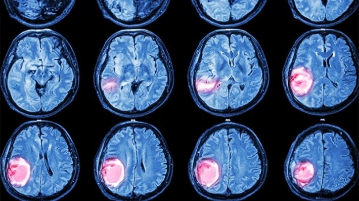 Beyin tümörlerinde 3 kritik sinyal!