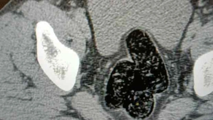 Bu uyuşturucu kaps&uuml;lleri İran uyruklu şahsın bağırsağından &ccedil;ıkarıldı