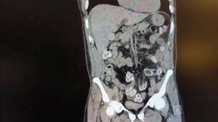 Fas&rsquo;tan Beşiktaş'a midesinde uyuşturucu getirdi: Ameliyatla &ccedil;ıkarıldı