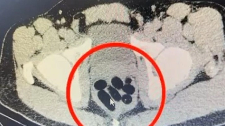 Kayseri'de uyuşturucu operasyonu: Midesinden çıkan şoke etti