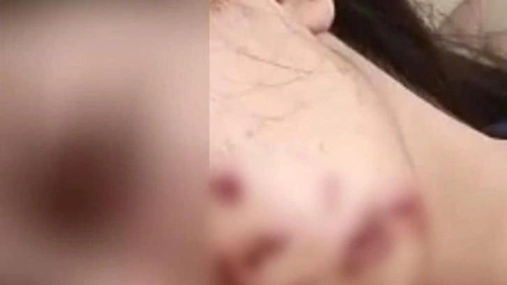 Yüzüne maytap isabet eden genç kız yaralandı