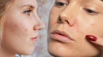 1 haftada ge&ccedil;meyen sivilce izleri nasıl ge&ccedil;er? Kırmızı sivilce lekelerine anında &ccedil;&ouml;z&uuml;m!