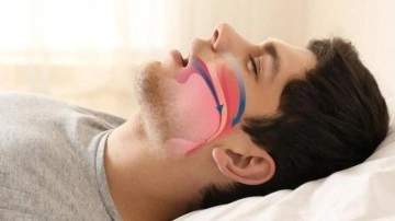 5 dakikada horlamaya son! Kadın ve erkeklerde horlamaya kesin &ccedil;&ouml;z&uuml;m ve tedavisi