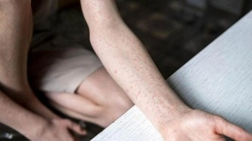 ABD'de kızamık vakaları artıyor