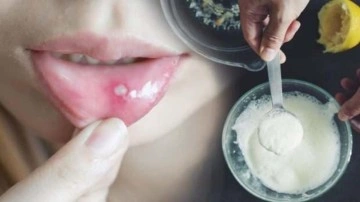 Ağız yarasına ne iyi gelir? Ağız i&ccedil;i yaralarını tedavi eden 5 bitkisel &ccedil;&ouml;z&uuml;m...