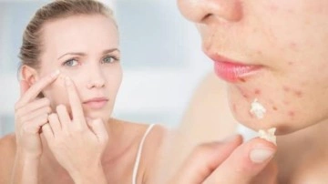 Aktif sivilce nasıl kurutulur? Sivilce izleri nasıl ge&ccedil;er?