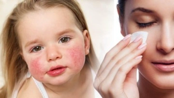 Alerjik ve hassas ciltlere mevsim ge&ccedil;işlerinde dikkat!