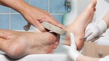 Ayakta ve elde nasır tedavisi! Evde nasır k&ouml;k&uuml; &ccedil;ıkarma y&ouml;ntemleri ve kesin &ccedil;&ouml;z&uuml;m&uuml;...