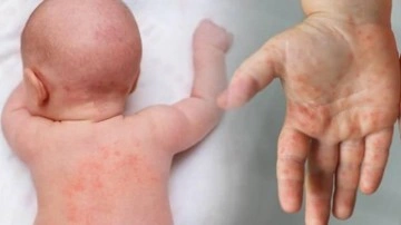 Bebeklerde pişik nasıl ge&ccedil;er? Kantaron yağı pişiğe iyi gelir mi?