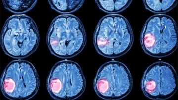 Beyin tümörlerinde 3 kritik sinyal!