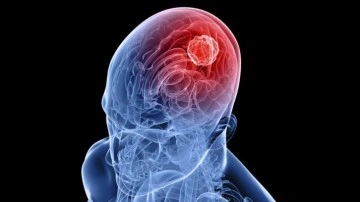 Beyin t&uuml;m&ouml;r&uuml; ameliyatında T&uuml;rkiye'de bir ilke daha imza atıldı