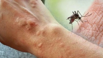 B&ouml;cek ısırığı şişmesine ne iyi gelir? B&ouml;cek ısırığı belirtileri nelerdir?