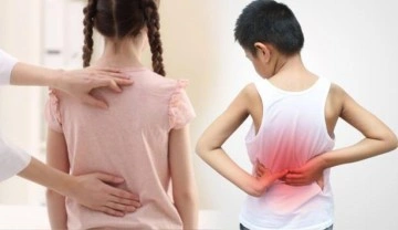 Boyları hızlı uzayan &ccedil;ocuklara dikkat! Skolyozun habercisi olabilir