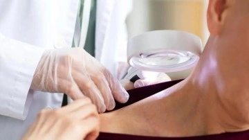 Cilt kanseri riskini 3 kata yakın artırıyor! Pop&uuml;ler diye yapmayın