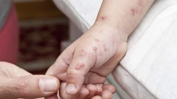 DS&Ouml;, maymun &ccedil;i&ccedil;eği vakalarında gelinen son rakamı a&ccedil;ıkladı