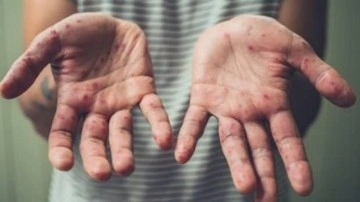 D&uuml;nya Sağlık &Ouml;rg&uuml;t&uuml;'nden umutlandıran maymun &ccedil;i&ccedil;eği &ouml;ng&ouml;r&uuml;s&uuml;