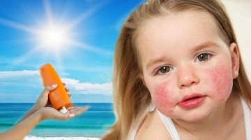G&uuml;neş alerjisine ne iyi gelir, nasıl ge&ccedil;er? G&uuml;neş alerjisi belirtileri&hellip;