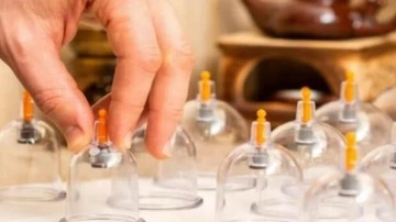 Hacamat nedir, faydaları nelerdir? Manevi hacamat b&ouml;lgeleri...