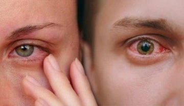 Halk arasında kırmızı g&ouml;z hastalığı olarak biliniyor: Konjonktivit salgını