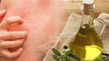 İsilik nedir, nasıl ge&ccedil;er? Yaz aylarında &ccedil;ıkan isiliğe zeytinyağı iyi gelir mi?