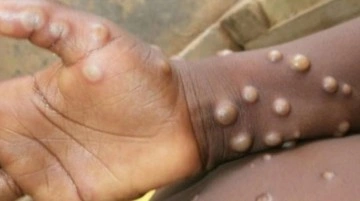 İspanya Sağlık Bakanlığı: 27 Avrupa &uuml;lkesi maymun &ccedil;i&ccedil;eği vir&uuml;s&uuml;ne karşı aşı satın alacak - Haberler