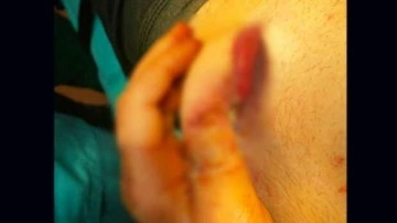 Kazada kopan parmağı, g&ouml;beğinde yeniden b&uuml;y&uuml;t&uuml;ld&uuml;