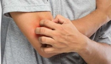 Koronavir&uuml;s&uuml;n bir etkisi daha: Deri d&ouml;k&uuml;nt&uuml;s&uuml;, cilt hastalıkları