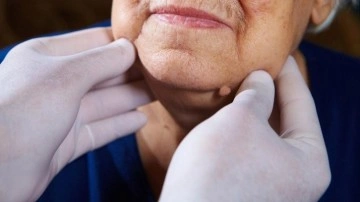 Lenf kanseri nedir, lenfoma kanseri belirtileri nelerdir? Lenf kanseri &ouml;l&uuml;mc&uuml;l m&uuml;d&uuml;r?