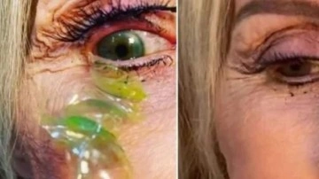 Lens takanlar dikkat! Hastanın g&ouml;z&uuml;nden &ccedil;ıkanlar şoke etti
