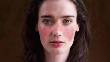 Lupus hastalığı nedir, belirtileri nelerdir? Lupus hastalığı &ouml;ld&uuml;r&uuml;c&uuml; m&uuml;d&uuml;r, tedavisi nedir?