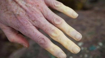 Lupus hastalığı nedir, belirtileri nelerdir? Tedavisi var mıdır? &Ouml;l&uuml;m oranı nedir?