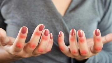 Lupus hastalığı nedir? Lupus hastalığı &ouml;ld&uuml;r&uuml;c&uuml; m&uuml;d&uuml;r? Lupus belirtileri ve tedavisi