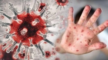 Maymun &ccedil;i&ccedil;eği belirtileri nelerdir? Maymun &ccedil;i&ccedil;eği vir&uuml;s&uuml; tedavisi...