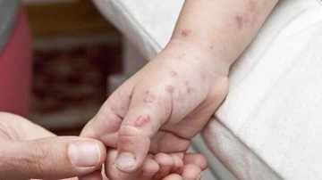 Maymun &ccedil;i&ccedil;eği vir&uuml;s&uuml;ne karşı kritik 2 uyarı: Mesafe ve temasa dikkat