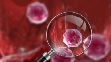 Miyeloid L&ouml;semi nedir? Kronik Miyeloid L&ouml;seminin belirtileri