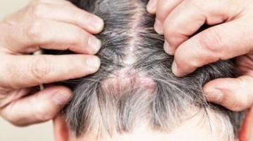 Sedef hastalığının kesin tedavisi var mı? Uzmanı a&ccedil;ıkladı: &Ccedil;eşitleri ve ilacı...