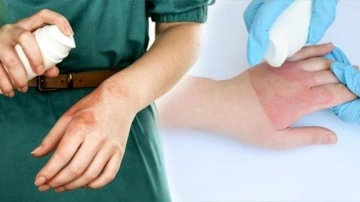 Su toplayan yanığa ne iyi gelir? Yanık i&ccedil;in doğal tedavi y&ouml;ntemleri...