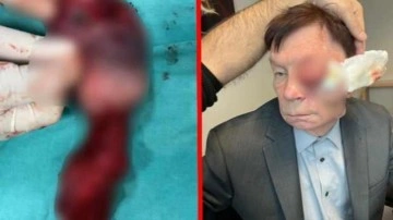 &Uuml;lkesinde 'yaşamaz' demişlerdi! T&uuml;rkiye'ye geldi, y&uuml;z&uuml;nden 2 yumruk t&uuml;m&ouml;r &ccedil;ıkarıldı