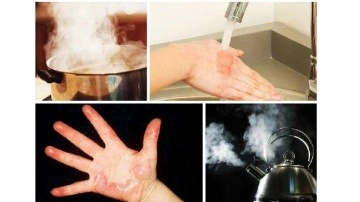 Yanıktan sonra su toplaması ka&ccedil; g&uuml;nde ge&ccedil;er? Su toplayan yanık patlarsa ne yapmalı?