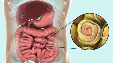 Yetişkinlerde kıl kurdu belirtileri: Kıl kurdu nasıl d&ouml;k&uuml;l&uuml;r?