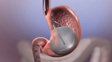 Yutulabilir mide balonu nedir nasıl uygulanır zayıflamada yeni trend!