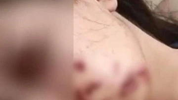 Yüzüne maytap isabet eden genç kız yaralandı